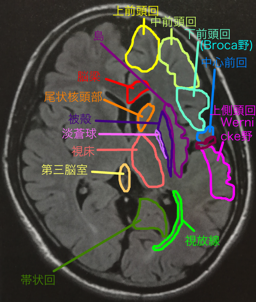 健忘性失語症(失名詞)の特徴、症状とコミュニケーション改善のための関わり方 | 自分でできるボディワーク