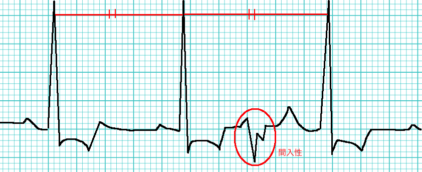波形 Vpc 4 患者急変時のモニター波形