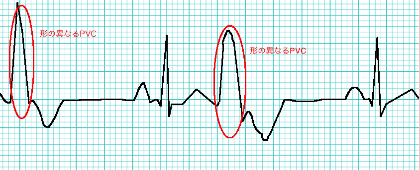 リハに役立つ 危険な心室期外収縮 多源性 のモニター心電図の見方