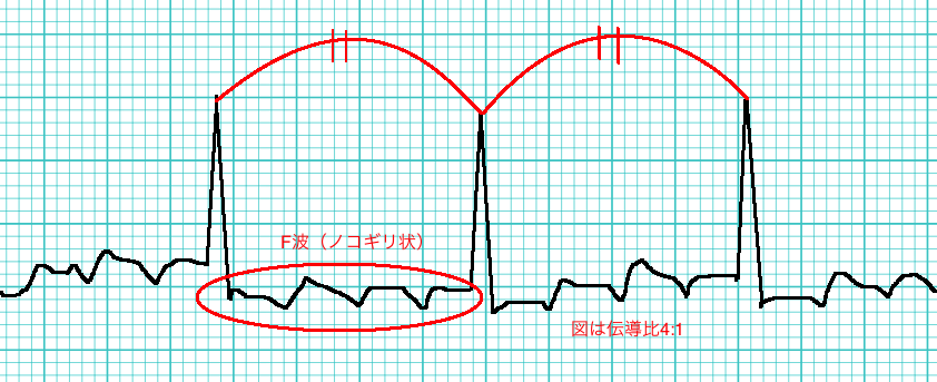 リハに役立つ、心房粗動（AFL）のモニター心電図の見方！リハに役立つ、心房粗動（AFL）のモニター心電図の見方！！