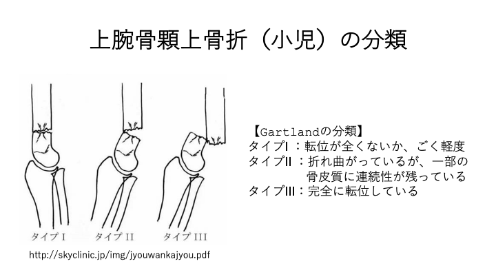 顆上骨折の見通し